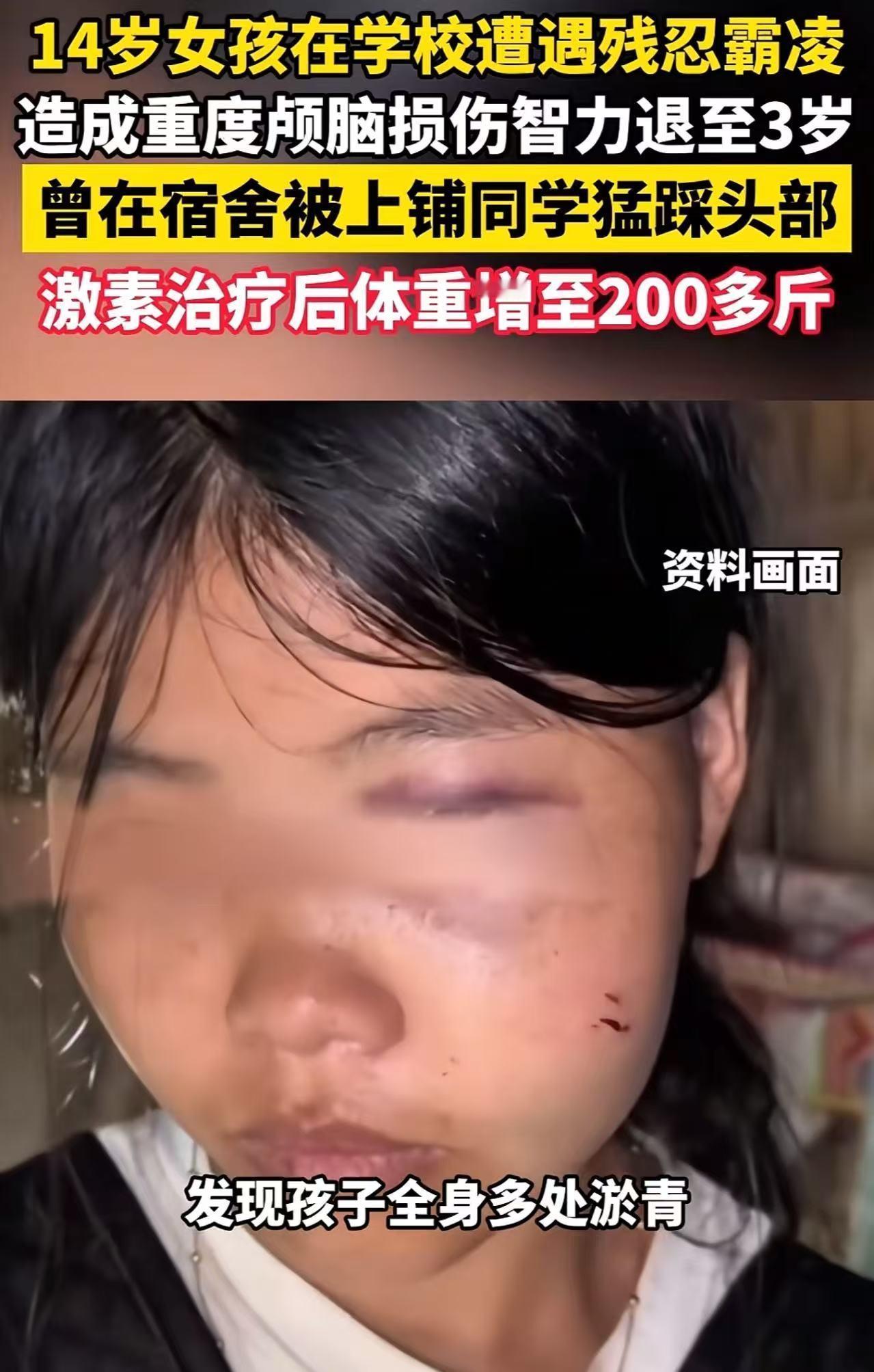 “未成年人保护法到底保护谁？”山西原平，14岁女孩在学校遭2名同学长期殴打，造成