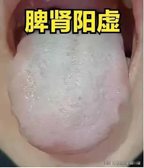 舌白厚腻伴裂纹凹陷？脾肾阳虚需双补，两丸搭配暖根本
 
伸出舌头，若见舌苔厚腻发