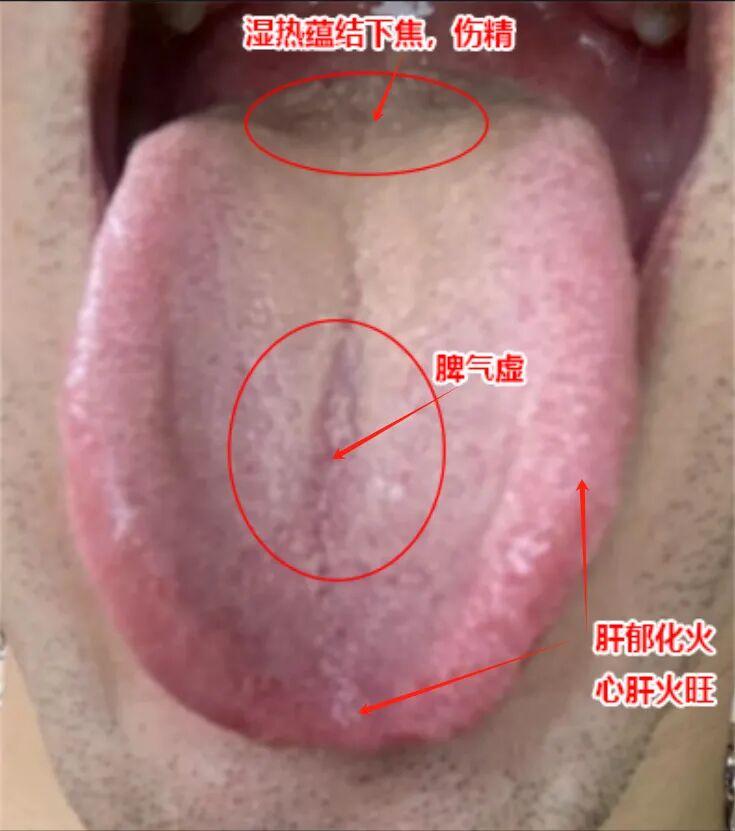 对这种舌象，需三管齐下，方能奏效。
患者主诉：性能力有所下降，与同龄人相比显得不