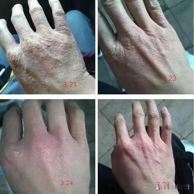 秋冬一定要买这个南非手足防裂小绿膏

父母年纪大了，一到秋冬🍂手脚容易裂
一裂