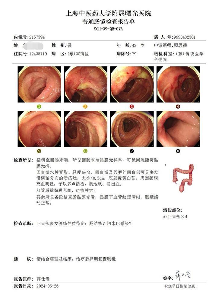 这是炎症性肠病吗？ 不是，患者也排除了结核。 最可能的是阿米巴原虫感染...