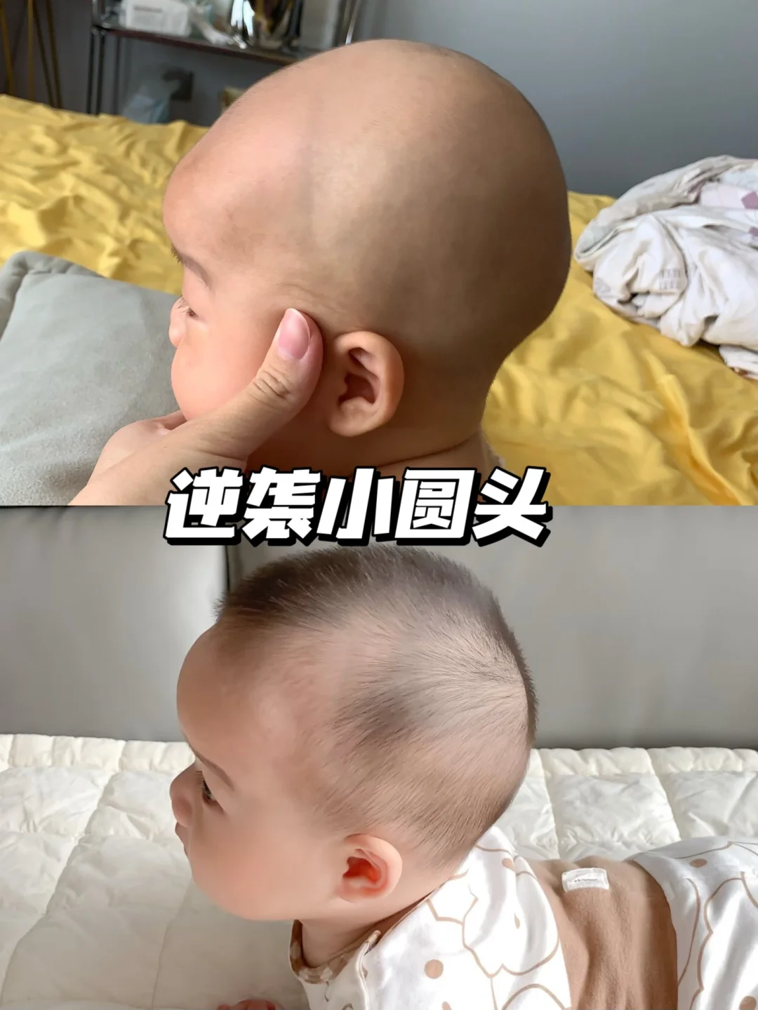 枕骨突出睡圆头成功啦！这些坑不要踩！