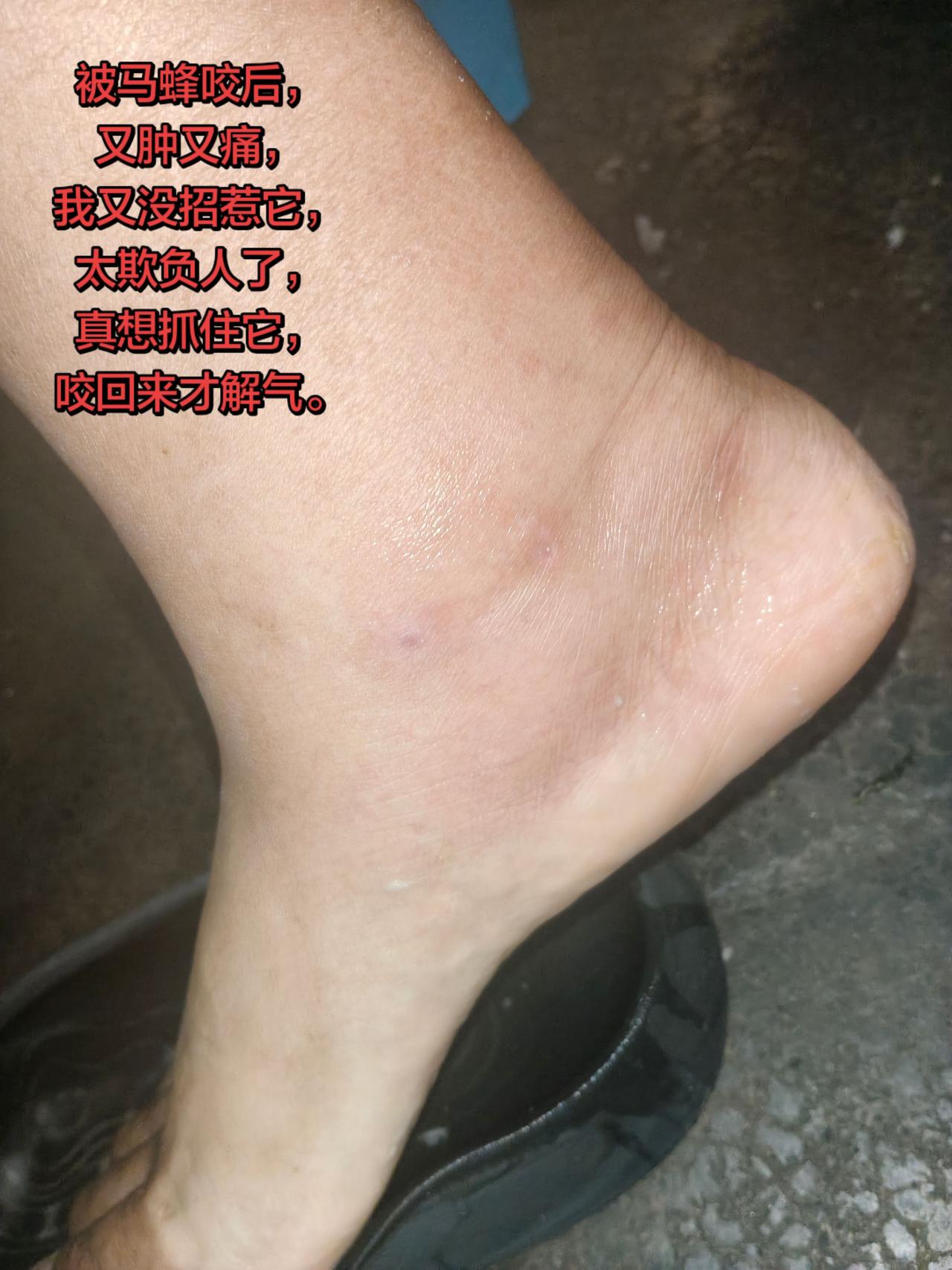 被马蜂咬后，
又肿又痛，
我又没招惹它，
太欺负人了，
真想抓住它，
咬回来才解