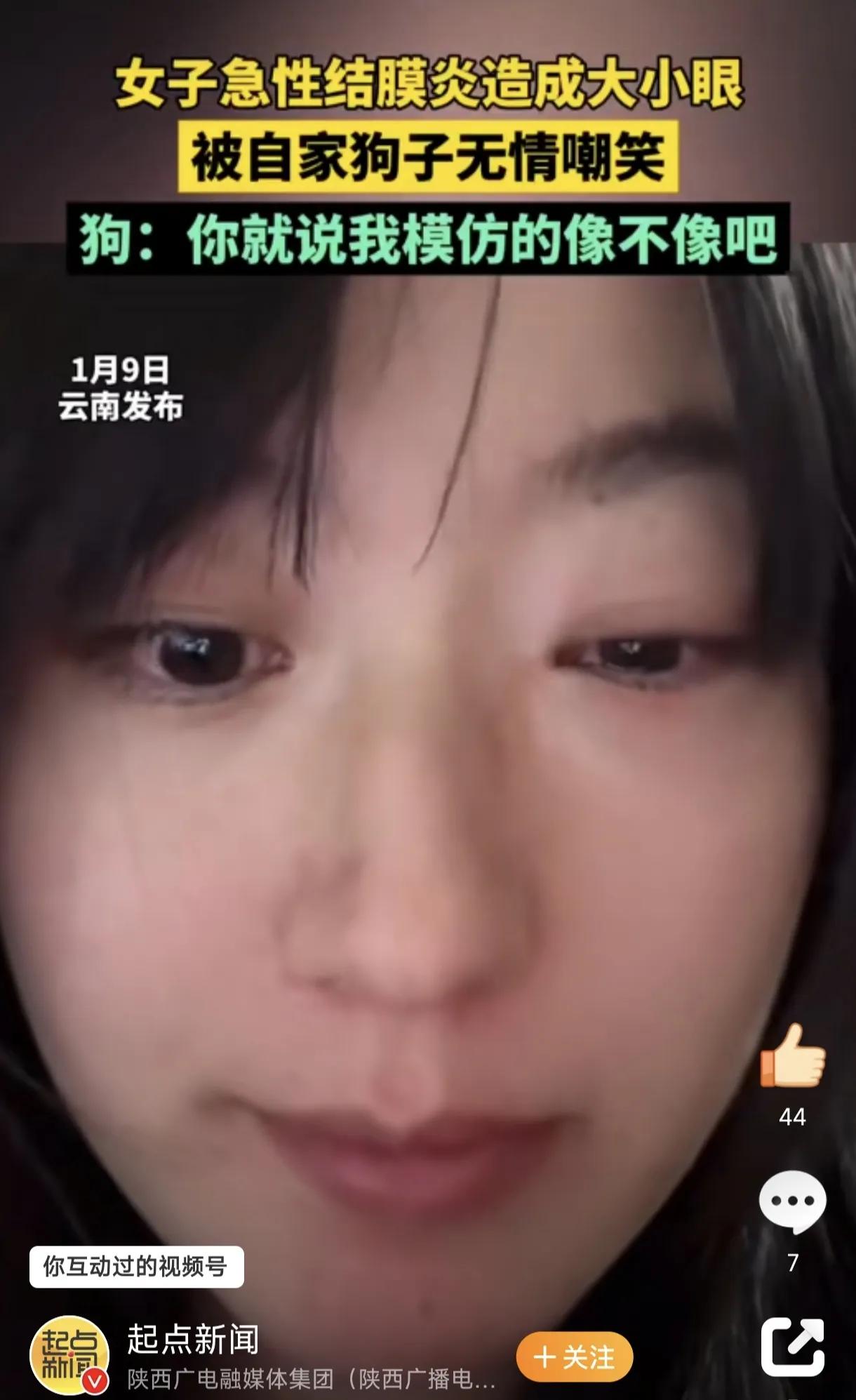 女子结膜炎大小眼被狗子无情模仿
近日，云南昆明的一位网友罗女士因为得了急性结膜炎