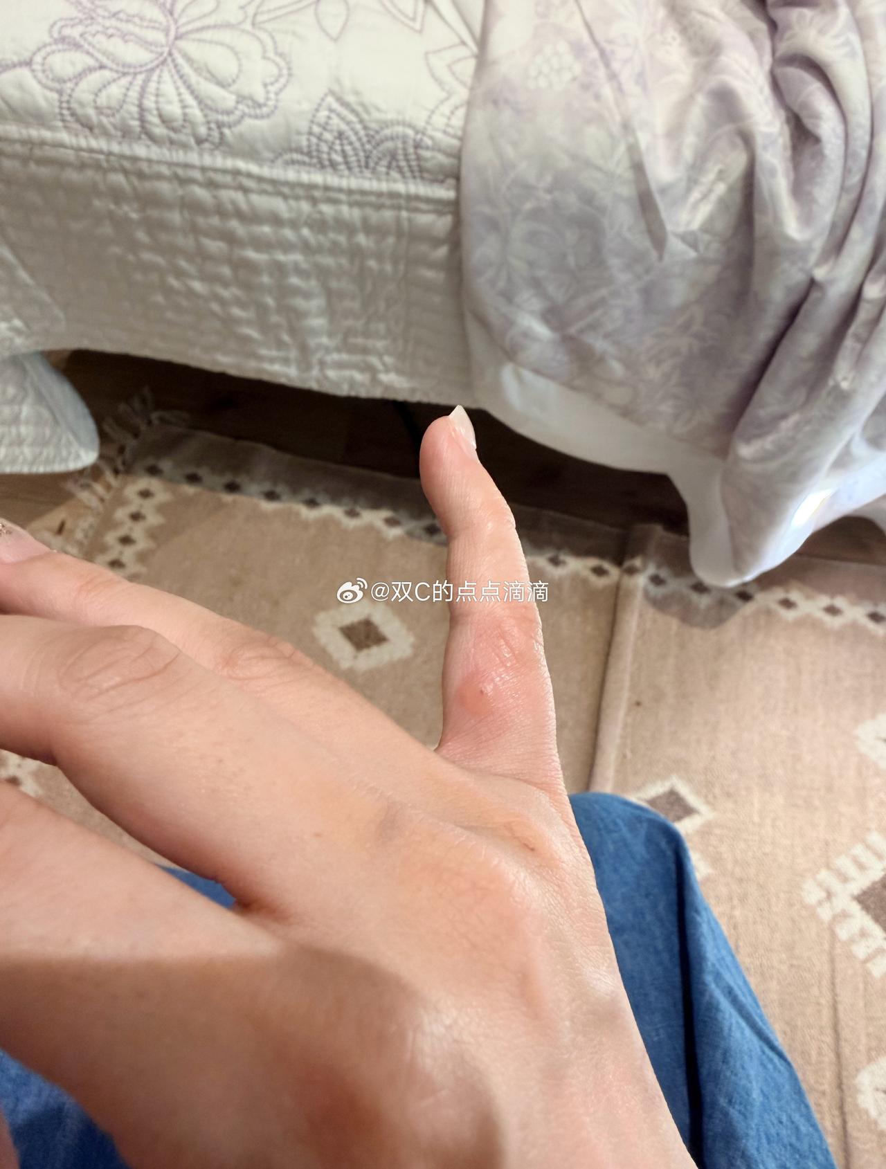 嗷嗷我手指起了一个泡
有点痒就抓了一下
结果变成一个很大的…

药店给我一个什么