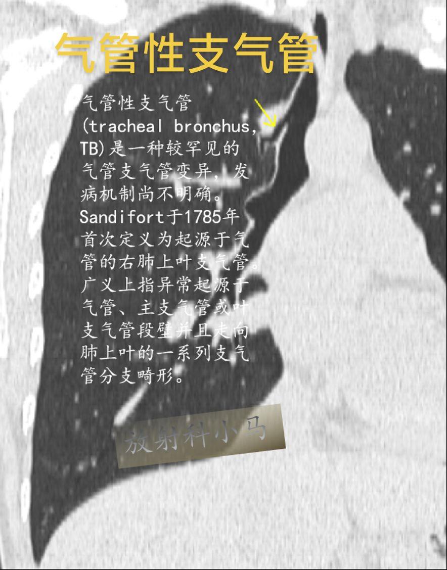 气管性支气管(tracheal bronchus，TB)是一种较罕见的气管支气管变异，发病机制尚不明确。Sandifort于1785年首次定义为起源于气管的右肺上叶支气管。广义上指异常起源于气管、主支气管或叶支气管段壁并且走向肺上叶的一系列支气管分支畸形。
根据气管性支气管是否移位分为两型，即移位型和额外型。移位型较常见，是指原正常起源气管隆突以远的上叶支气管的叶或段移位至气管。额外型少见，是指原支气管开口及其分支正常，在气管壁额外起源一气管性支气管，多余的气管性支气管可以供应肺实质，或为盲端形成气管憩室。