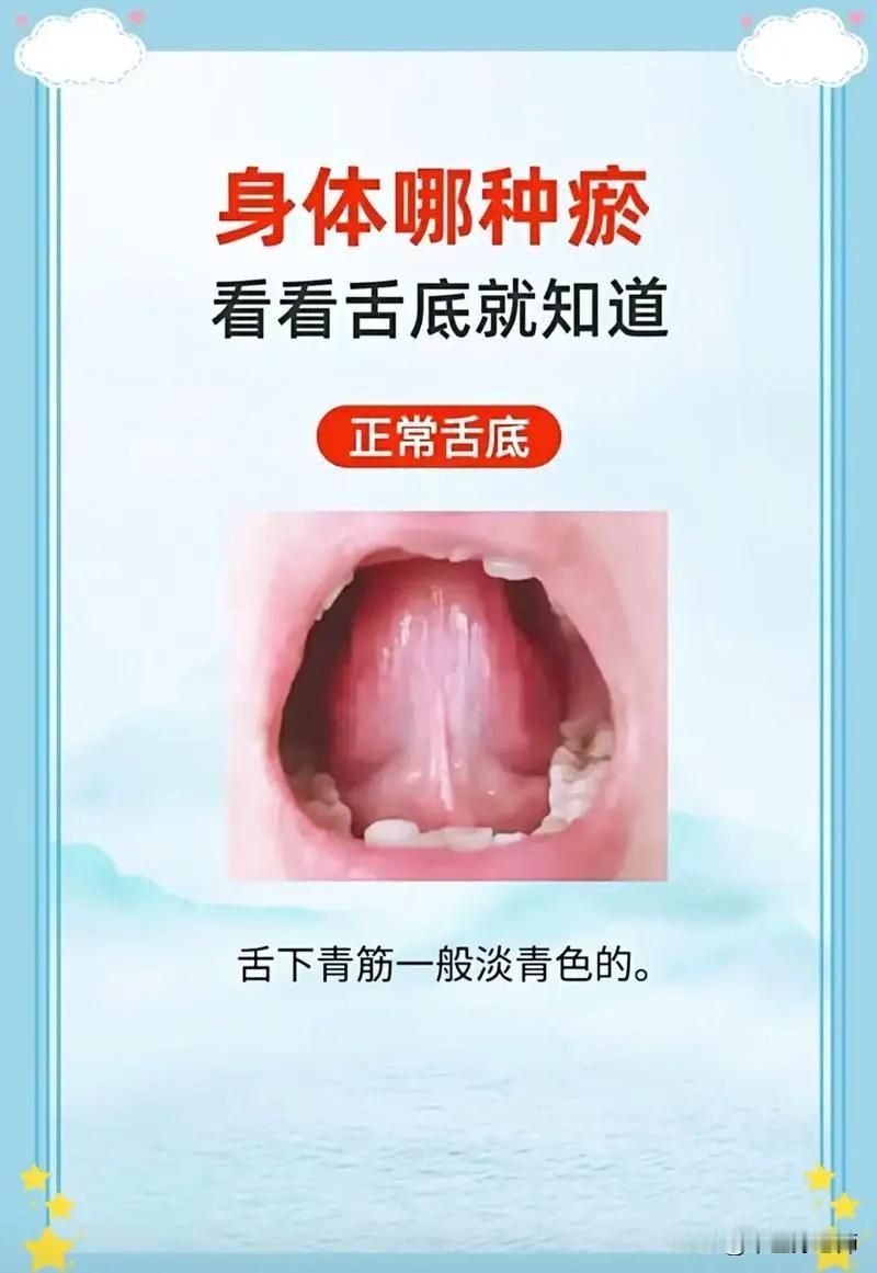 身体是哪种瘀，看看舌底就知道#健康##舌象##瘀血#