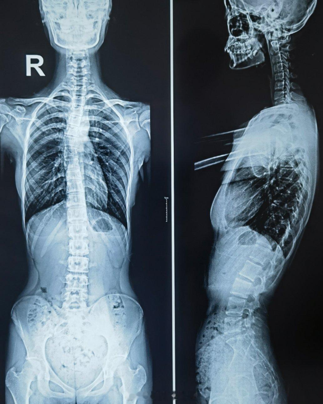 小姑娘16岁175cm，体重80斤，洗澡的时候妈妈发现双侧肩胛骨不对称来诊，拍脊