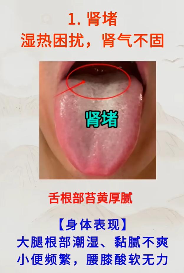 舌头藏着健康信号！分清心、肝、脾、肺、肾之堵