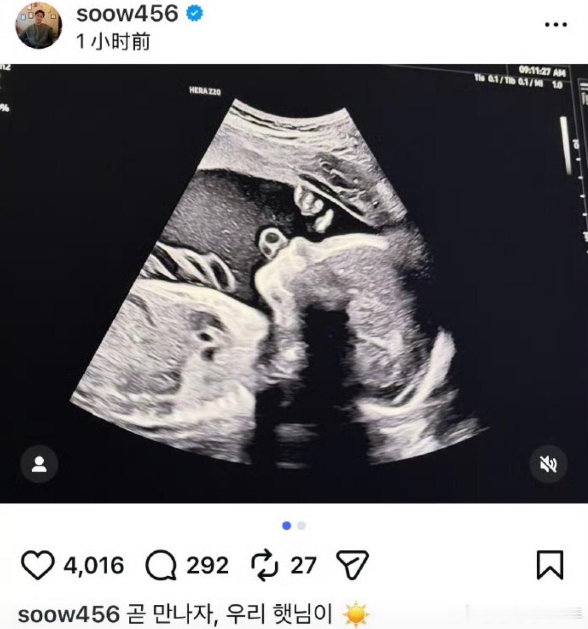 宋承炫宣布得子从早前晒出的B超影像，等到小宝宝平安降临，一家人迎来圆满新成员，往