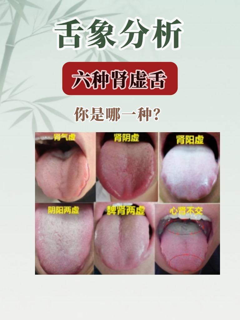 六种舌象。对照一下你是哪一种？