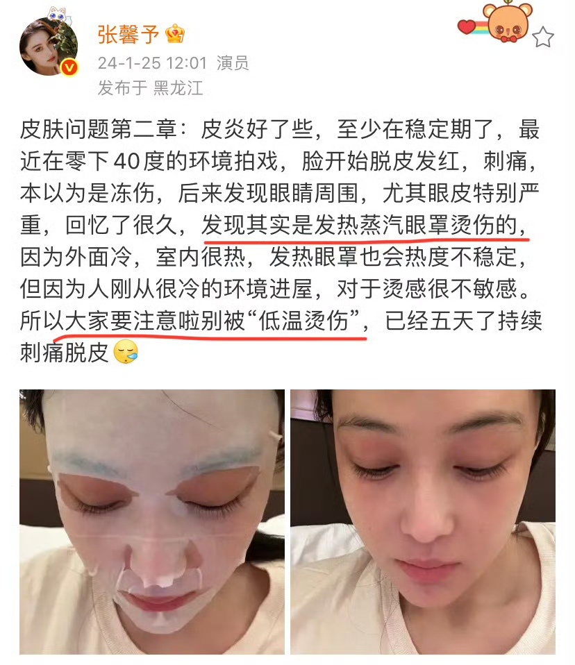 4月27日，杨幂晒图称遭蒸汽眼罩低温烫伤，眼下有两道明显红印，张馨予随后留言，坦