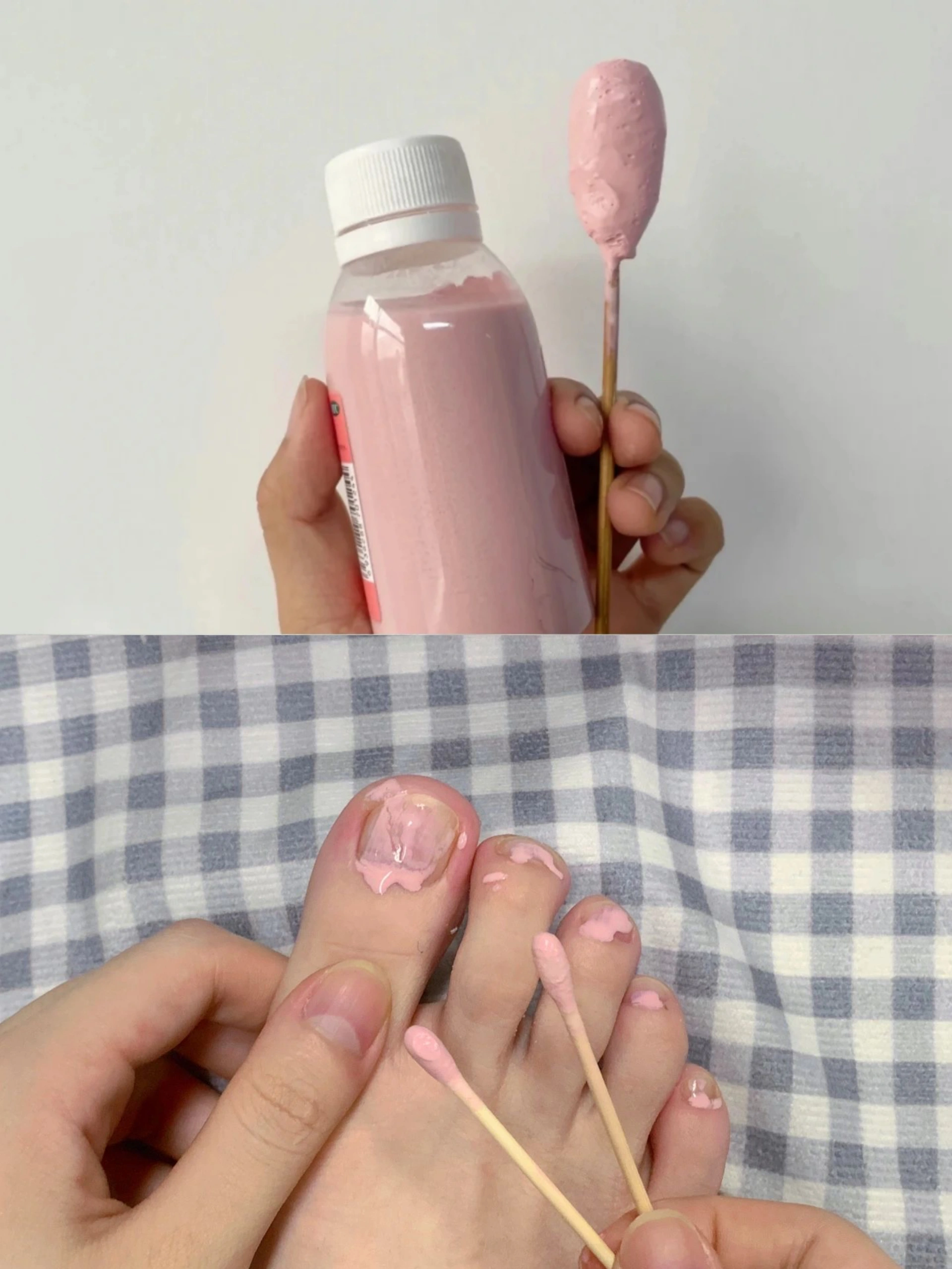 记录：从重度灰指甲到灰指甲没了应该怎么做