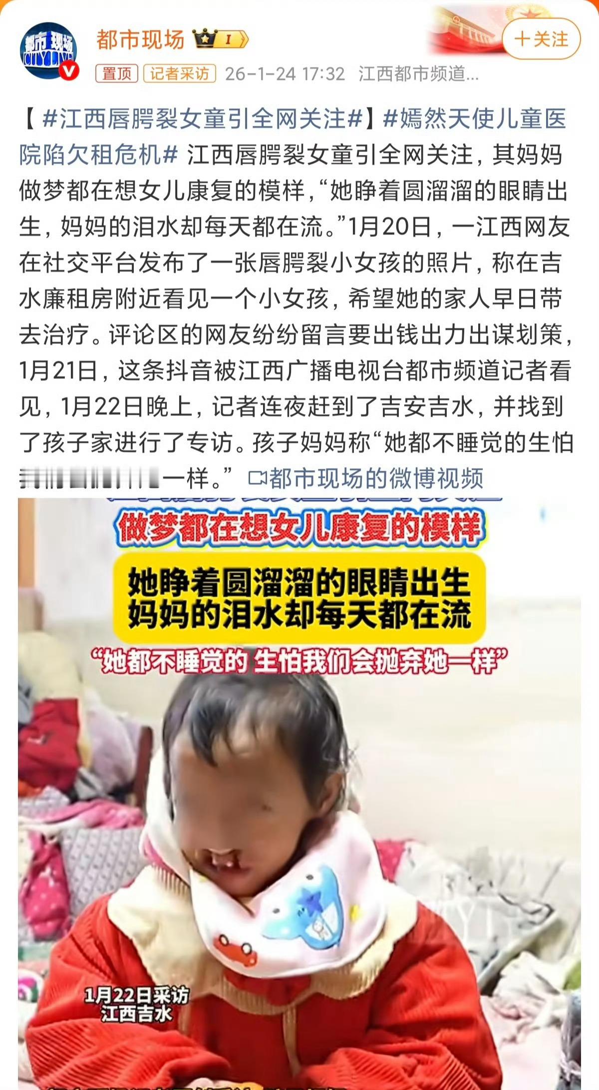 江西唇腭裂女童引全网关注 生孩子之前产检是很重要的！而且出生后为啥不第一时间治疗