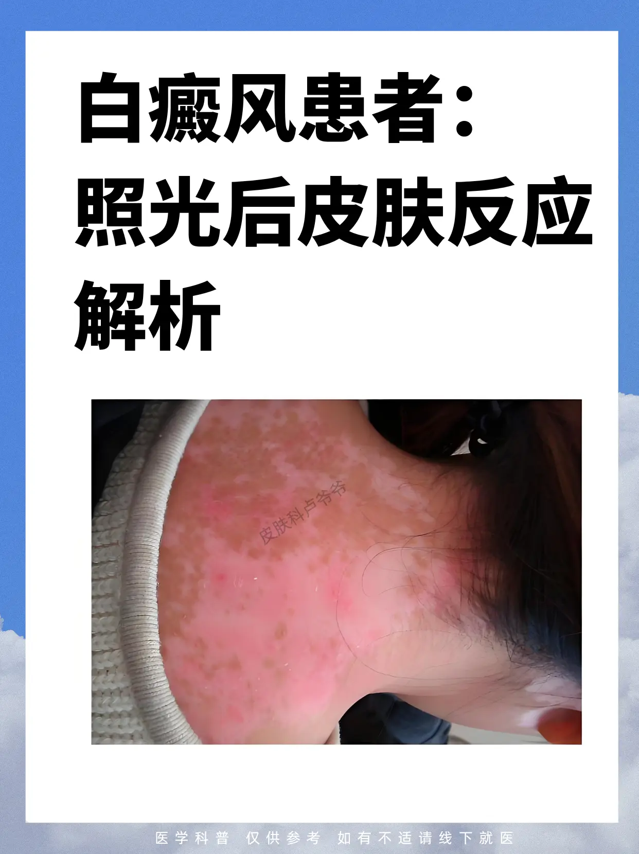 白癜风 白斑 白癜风科普 皮肤健康