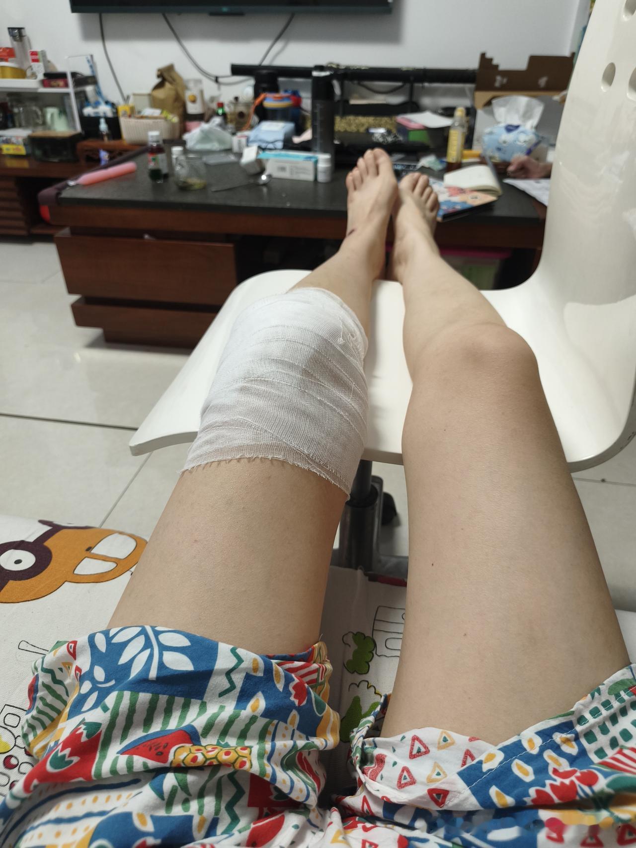 各位折友们，你们骨折以后都申请工伤了没有？公司都配合吗？
我们老板在我受伤之后第