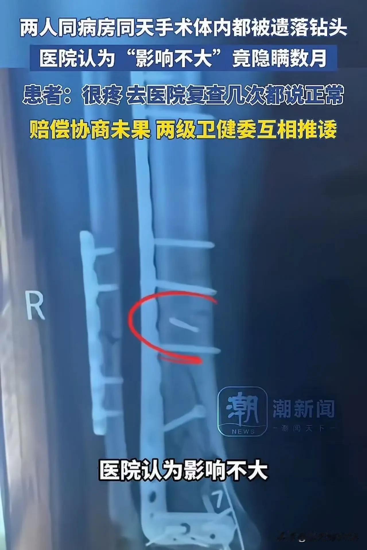 离了个大谱！湖南，两人同病房同一天手术，体内都被遗落钻头，医院竟然觉得“影响不大