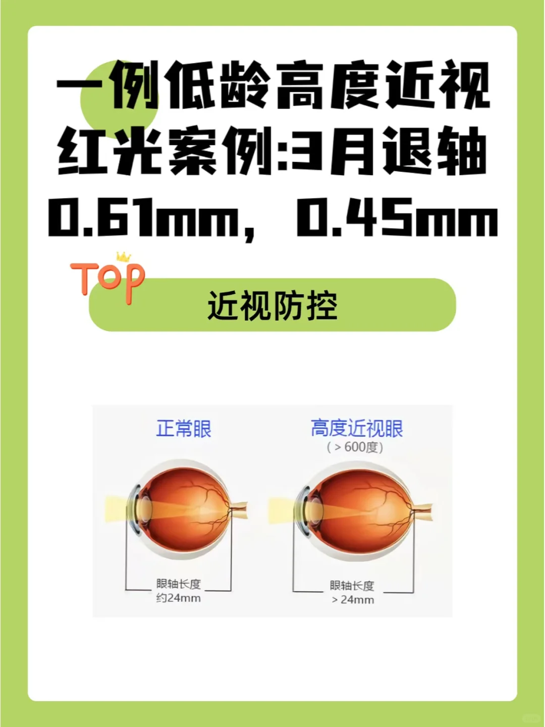 1例低龄高度近视红光案例