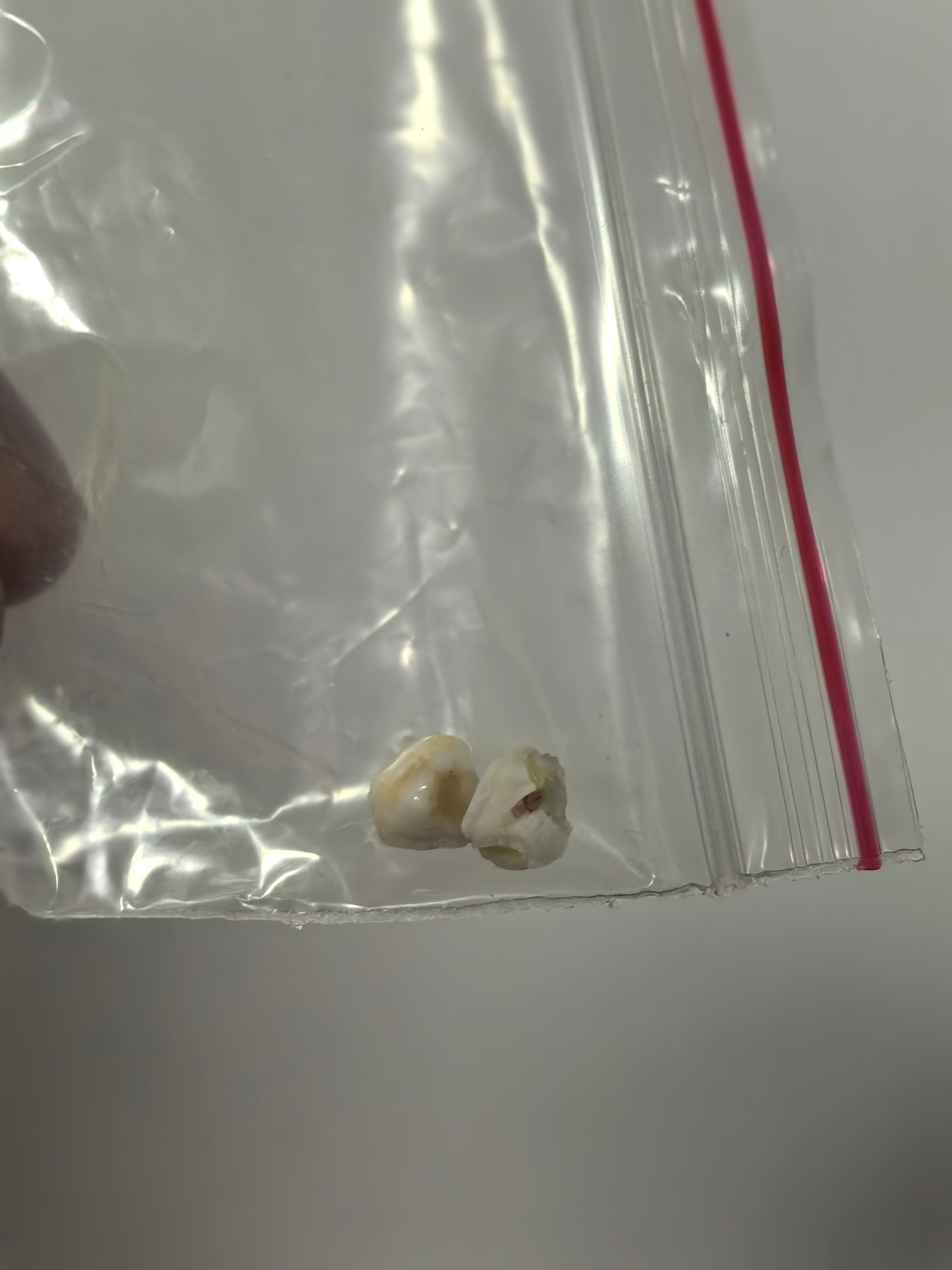6岁女童吃得太精细长出双排牙 波妞同学昨天晚上回来说，我又掉了一颗牙，下午加餐，