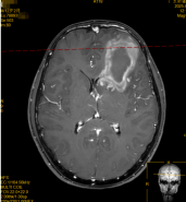 【！先天畸形+不良习惯引爆危机】熬夜打游戏至凌晨3点，次日突发头痛呕吐并晕厥，1