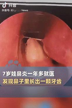 活久见！河南郑州，一7岁男孩因患鼻炎1年半，难受得不行，家长就带着他去医院，不料