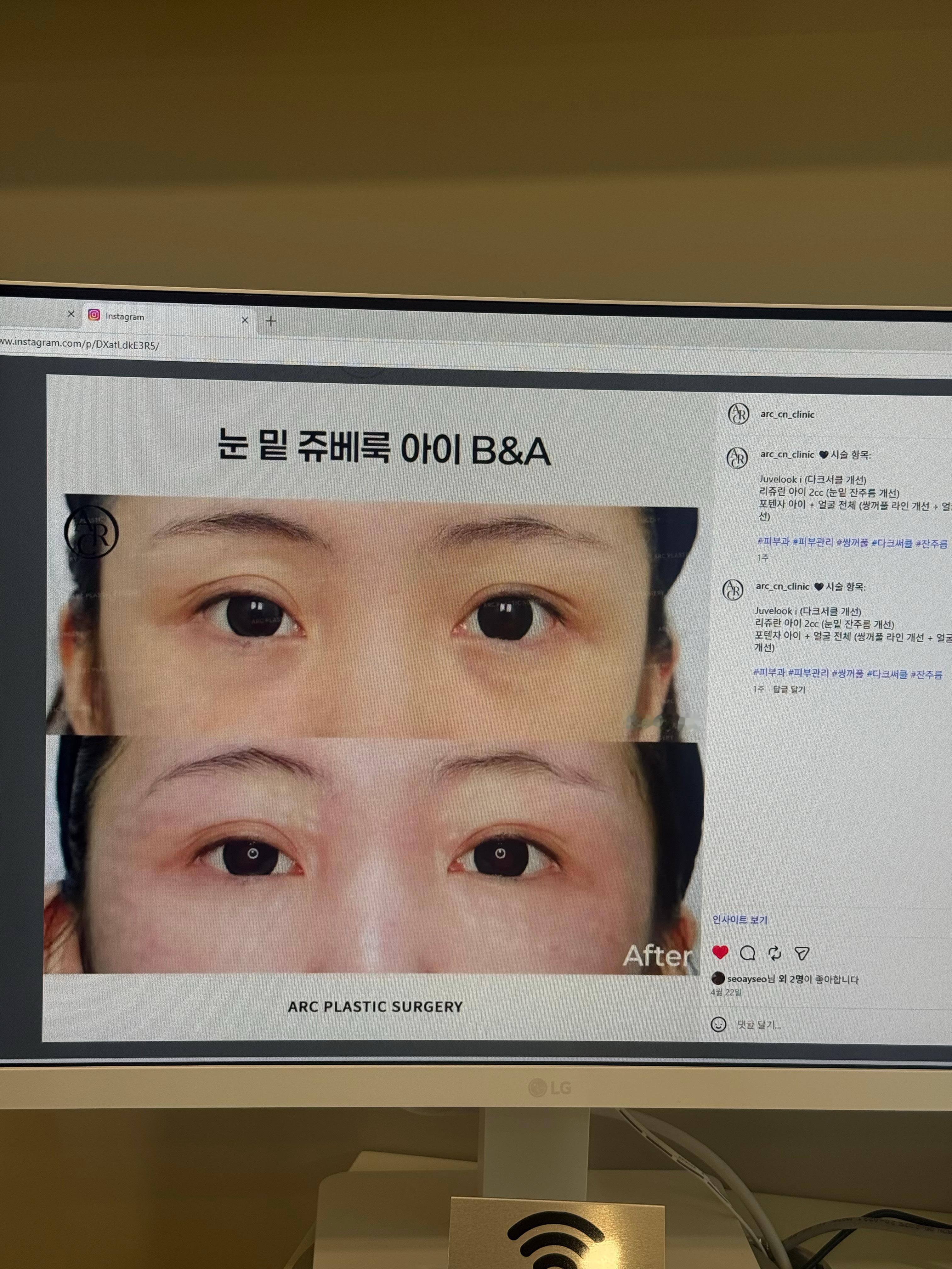 眼周抗衰还是非常有必要的。眼周黄金微针/眼部超声刀/眼部丽珠兰/眼部juveac