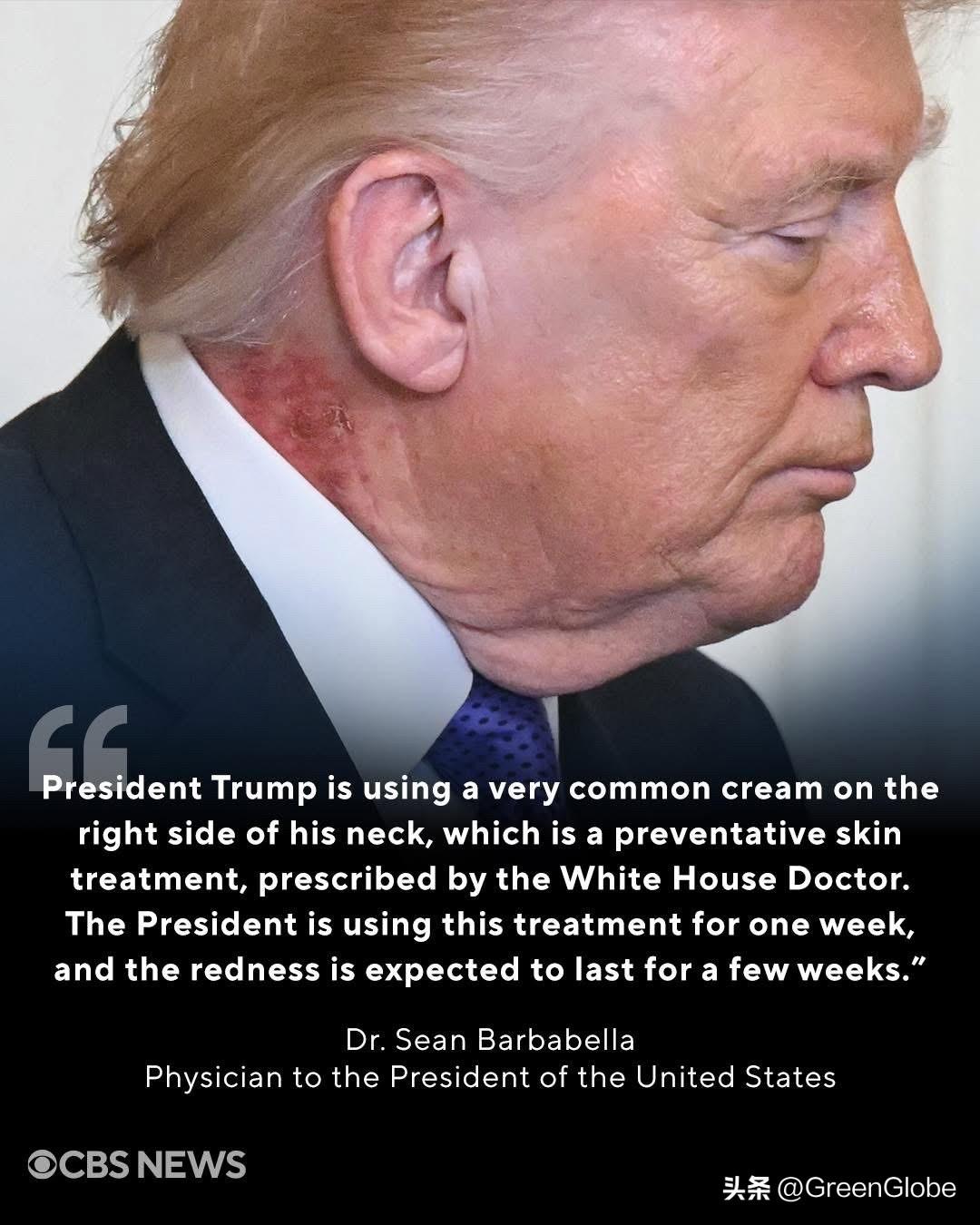 CBS报道，在本周一的荣誉勋章颁发仪式上，人们看到特朗普总统的脖子上似乎长有皮疹