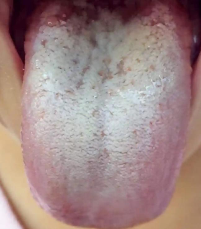 吃完就胀、嗳腐反酸？是食积裹着痰湿，把脾胃堵死了！
大家好，我是中医陈大夫！
好