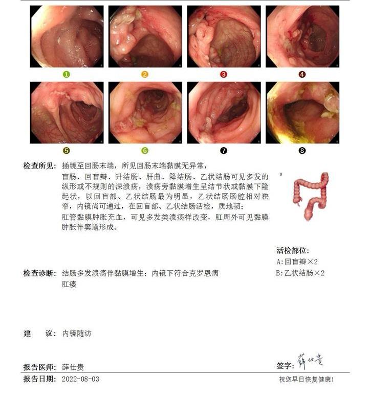 阶段性评估病情和监测药物是否失效很重要。21岁克罗恩病小伙子，近10年...
