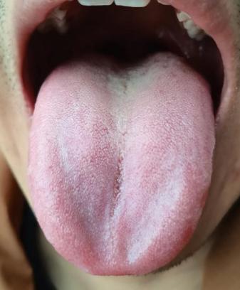 这种舌头，不赶快去疏肝，只会害了你自己！
 
患者：整天情绪低落，闷闷不乐，一点
