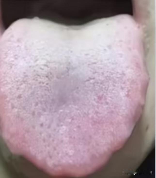 舌苔白腻，有齿痕，别傻傻健脾了，病根压根不在这

很多人一看白腻齿痕舌，第一个想