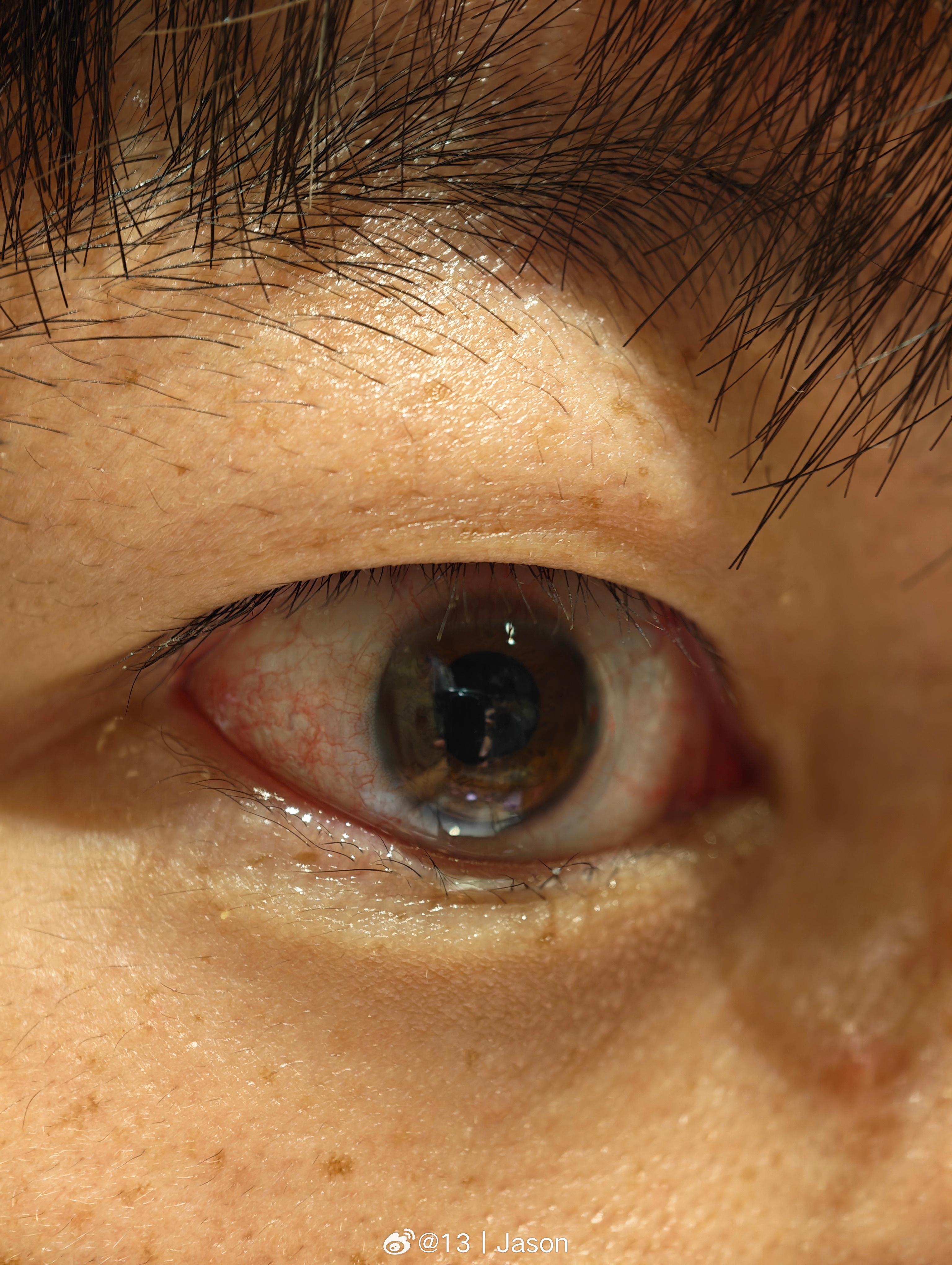 绷带镜也不是万能的嘛…该结膜炎还是会结膜炎。🥲 