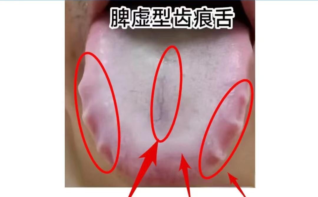 公益舌诊第46天，全程不收费，当场给出结果和调理方向！
 
齿痕盘踞难消？教你2