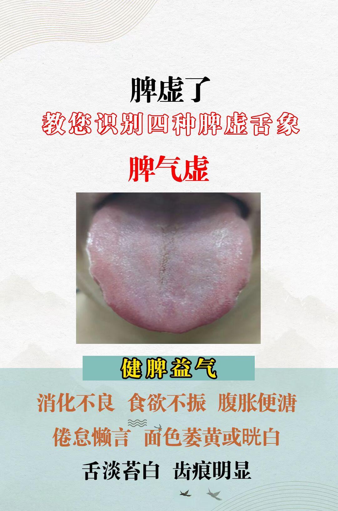 脾虚了 教你识别四种脾虚舌象