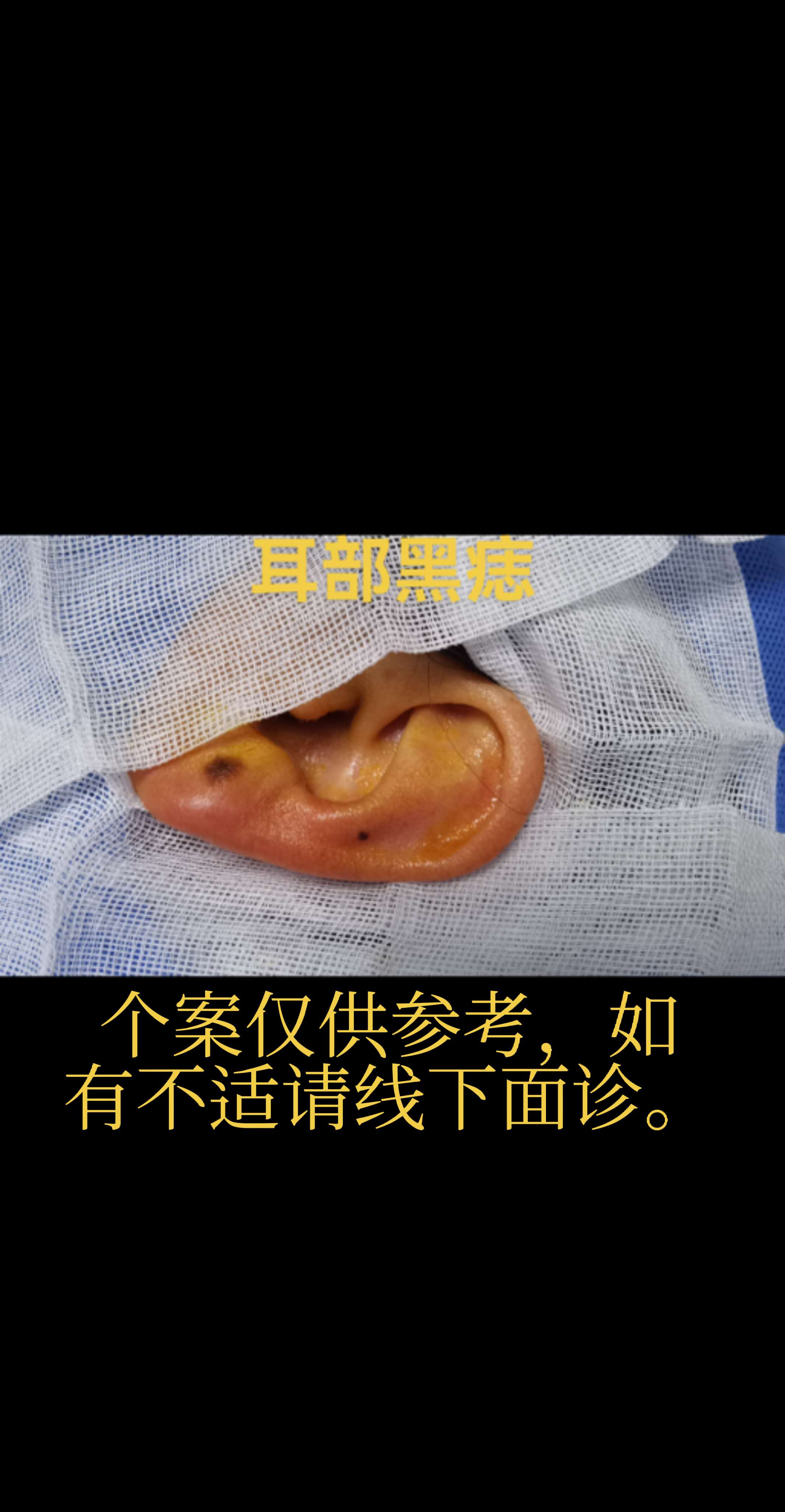 2个小黑痣。1个切除，1个激光祛除 黑痣祛除