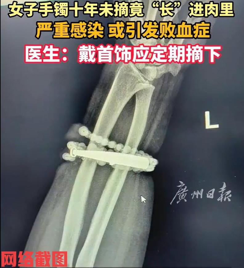 福建宁德有女子手腕处老是疼痛难忍。

女子去医院检查才得知这里的原因，竟然出在自