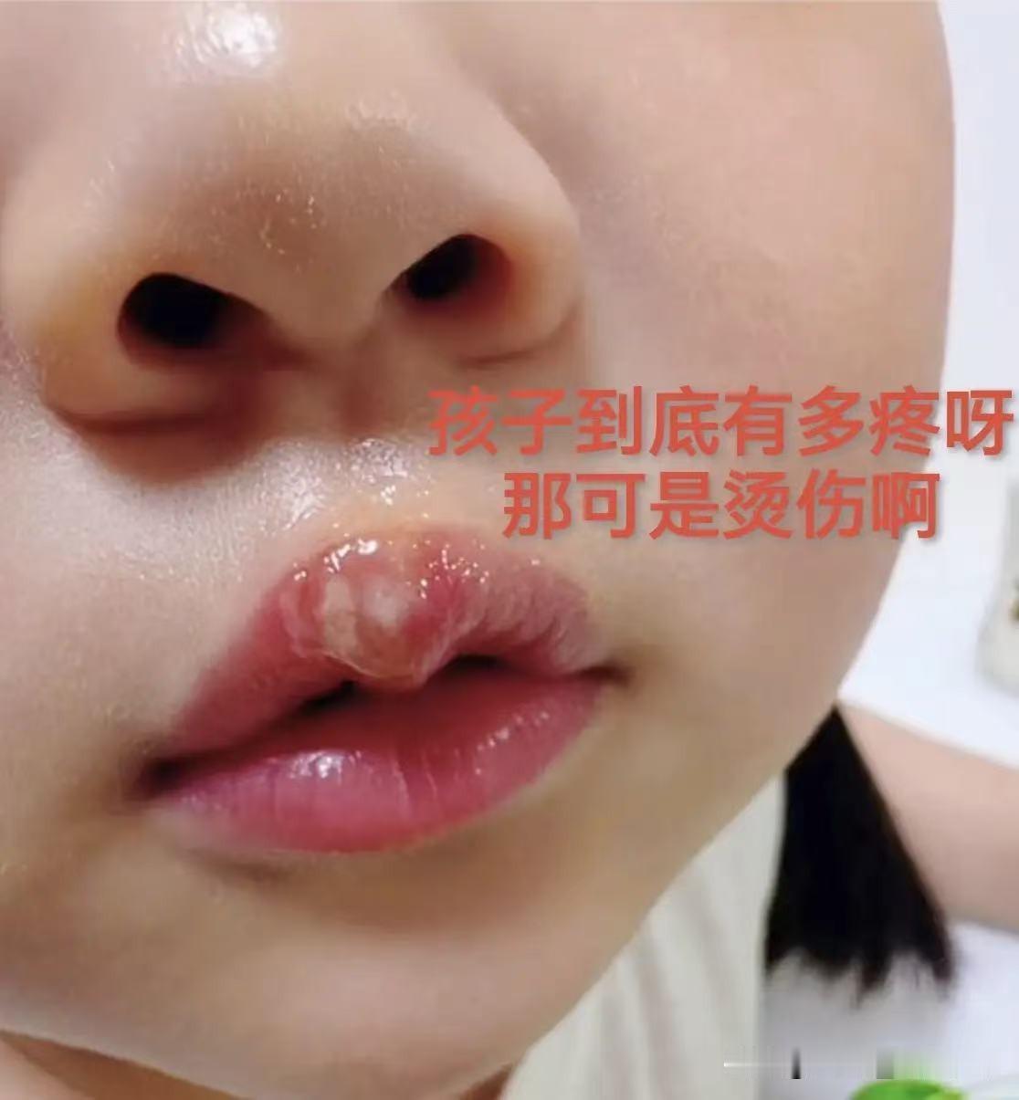 拿热熔胶烫幼儿嘴巴，这位幼师将要面临几大窘境:

第一、职业生涯彻底终结。身为幼
