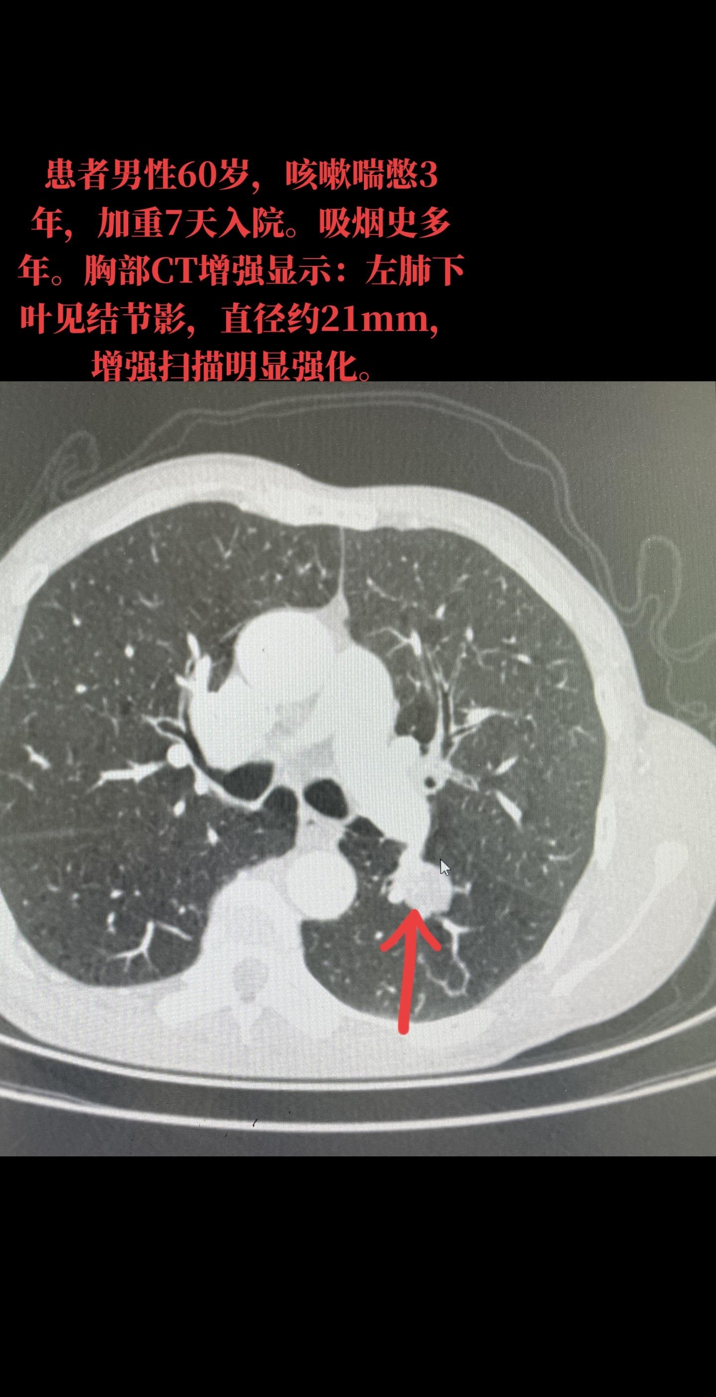 病例分享：左肺下叶中分化鳞状细胞癌，面积3.4*2.4cm，局部累及支气管软骨组织。病理分期：pT2aN0M0，ⅠB期