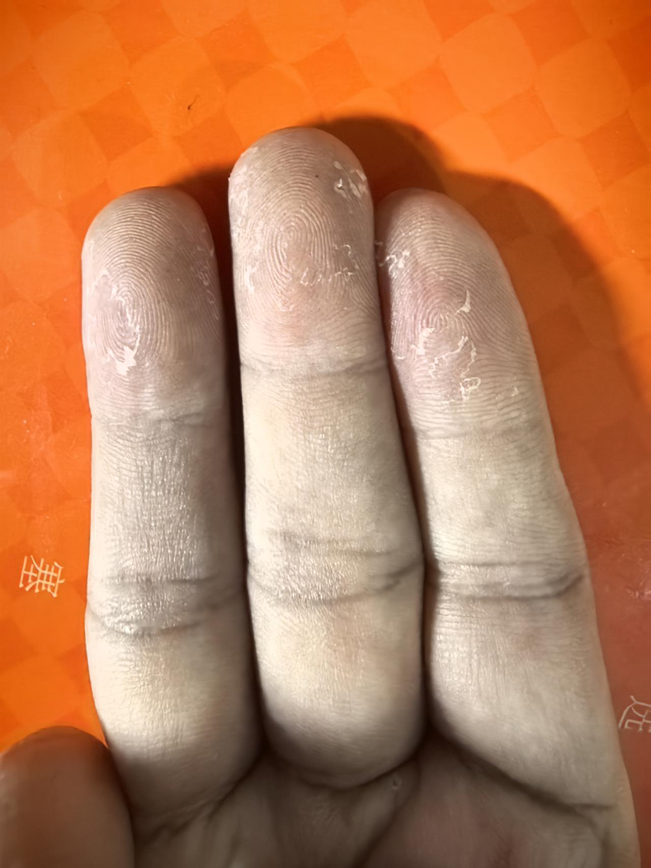 我这是缺少什么微量元素吗？
突然手指起了那么多皮。