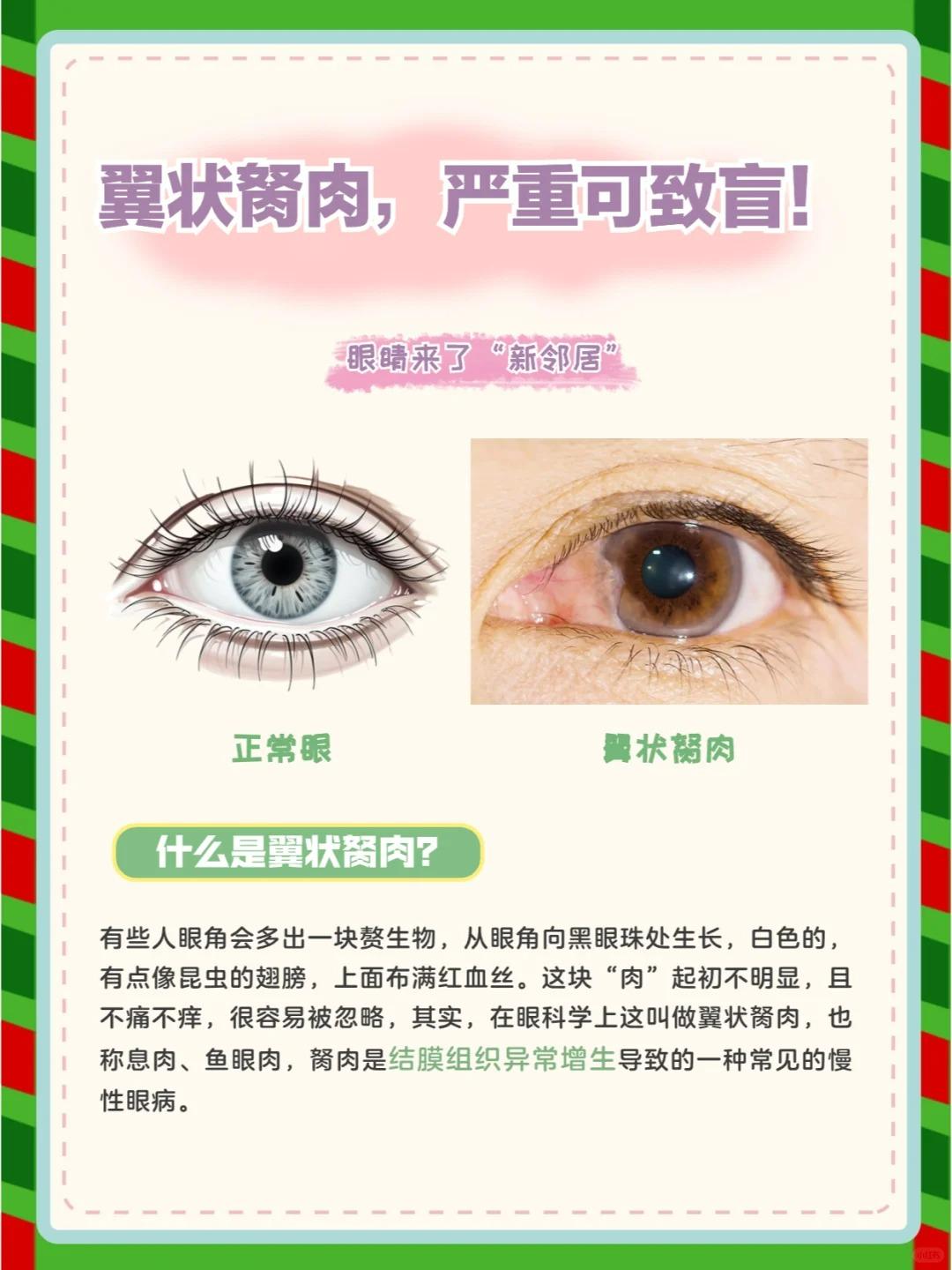 翼状胬肉，严重可致盲！ 😱
翼状胬肉， 是睑裂部球结膜与角膜上一种赘生组织，是
