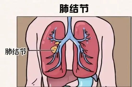 超四成网友认为结节是早期癌症结节，是在体检报告中频繁出现的词汇，许多人会下意识联