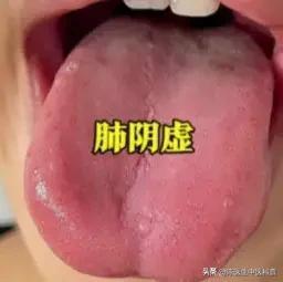 舌诊辨肺阴亏：舌红少苔需滋阴，百合固金方对症
 
很多人被长期干咳、咽喉干痒困扰