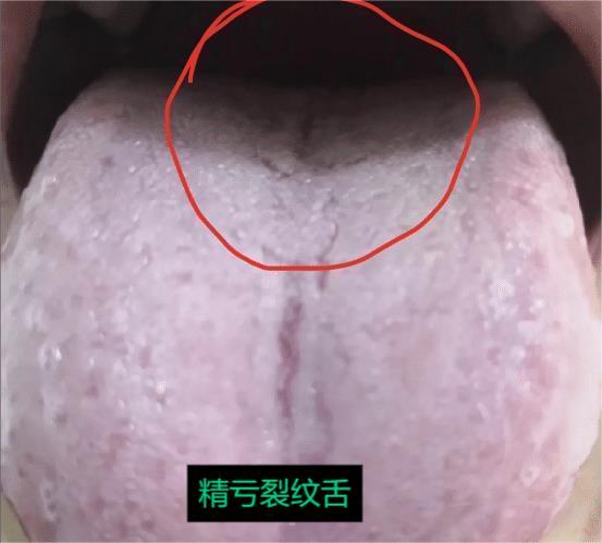 裂纹舌不只是脾虚，中医教你分清楚、怎么治

1、裂纹舌——精亏。
舌象：舌根裂纹
