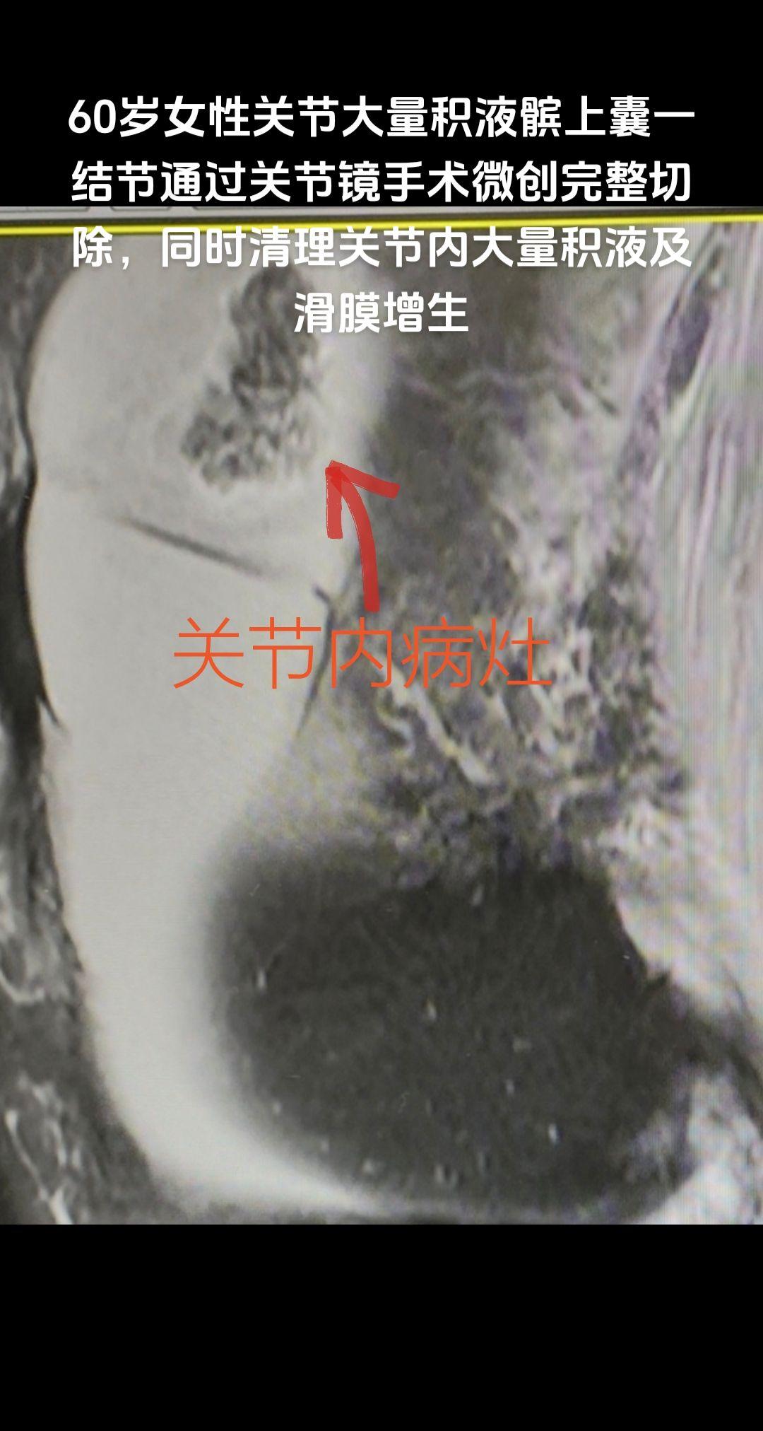 膝关节内占位微创完整切除。