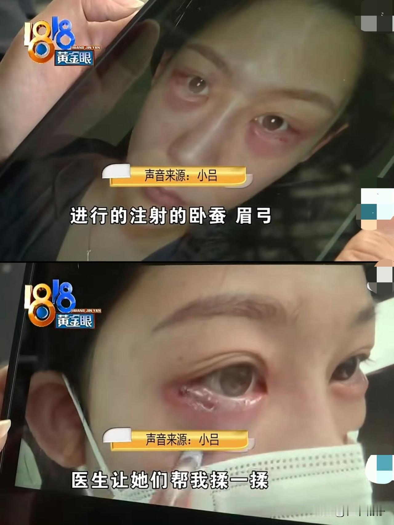 小吕两年前去杭州一家医院做了面部注射，后来卧蚕出现了过敏肿胀，几次溶解操作后，眼