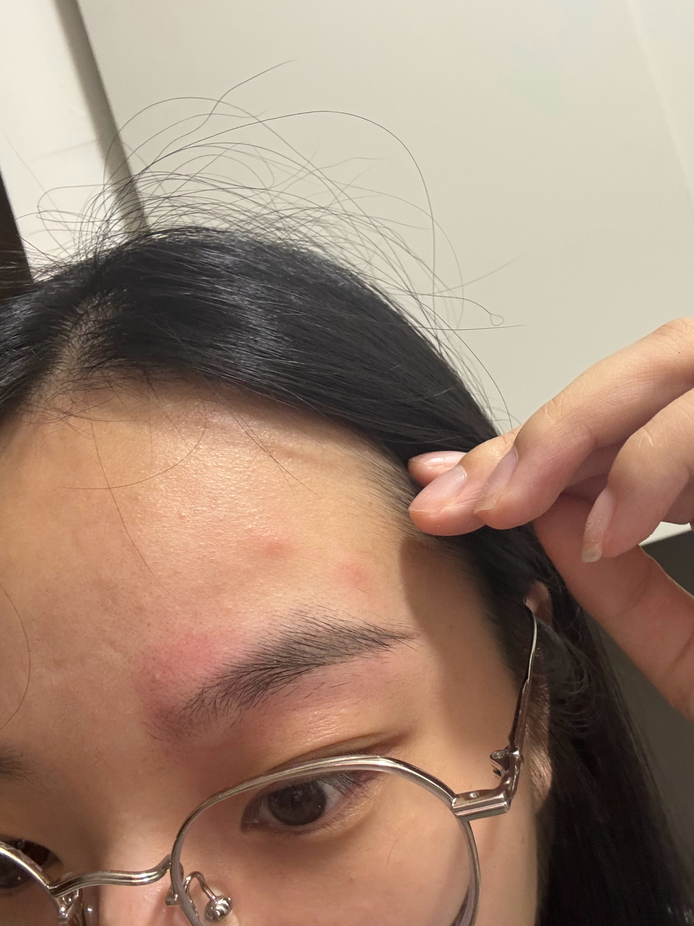我额头被咬到了三个蚊子包… 