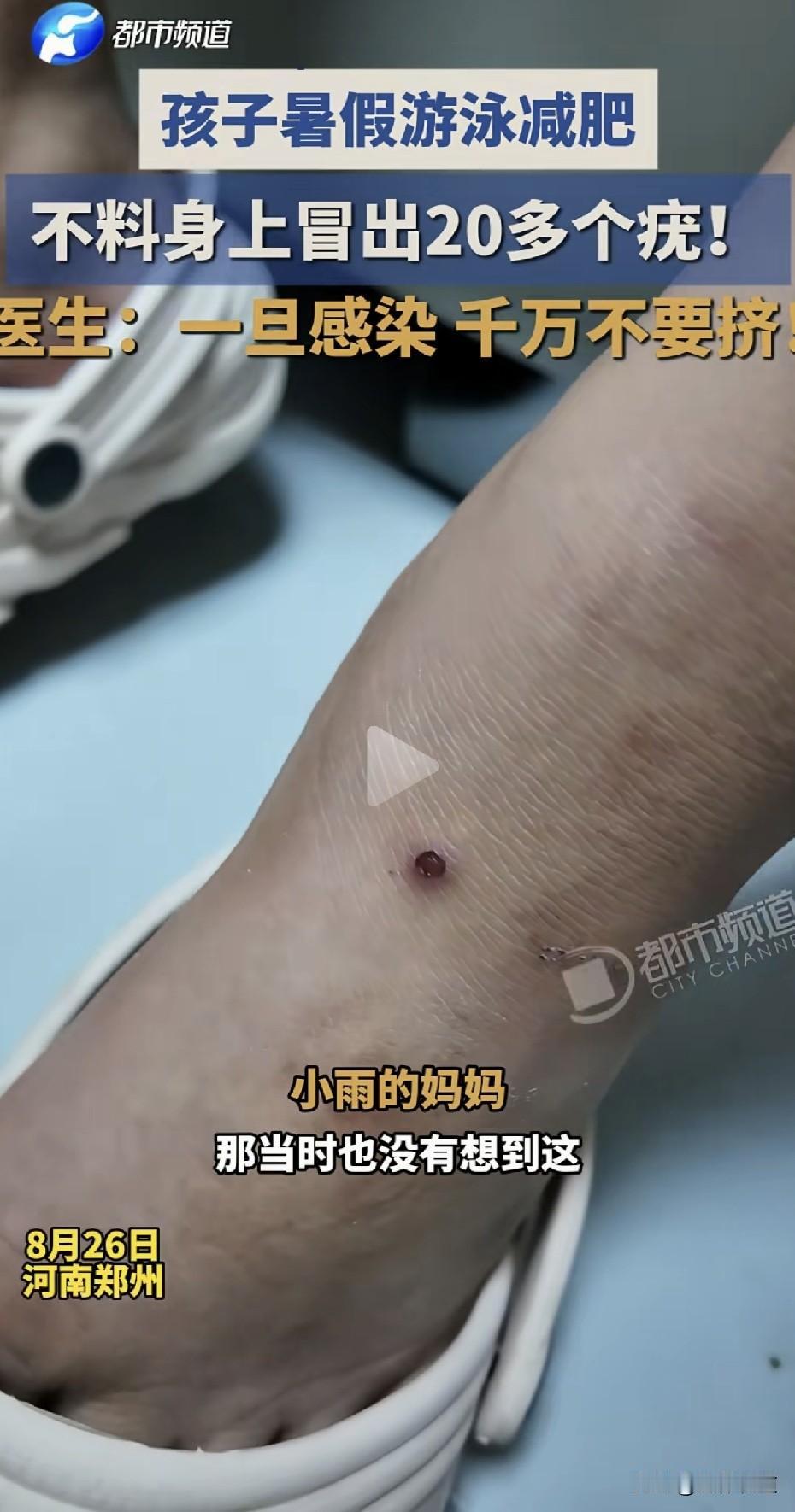 游个泳长20多个疣！河南一名女孩小雨趁暑假去游泳减肥，游了20多天后，全身竟冒出