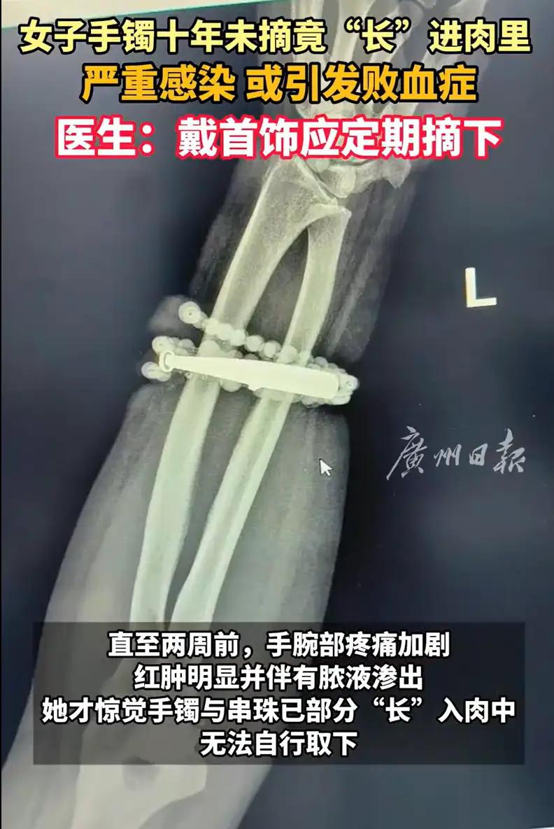 “万万没想到”！福建宁德，女子发现手腕的位置反复疼痛发痒，开始还以为是皮肤发炎，