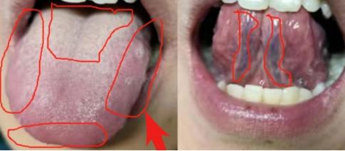 这种舌头，血管已经完全堵死！我仅用4味药小方，花小钱办大事！舌底青筋彻底消了！