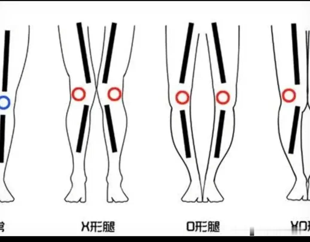 你检查过没有，你的两条腿还能并拢到一起吗？

记得几年前，我曾经看过央视的一个《